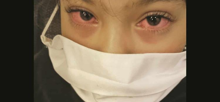 Covid-19 causa daño a los ojos
