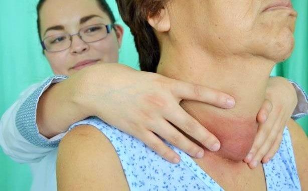 Valles municipio más afectado por ‘tiroides’