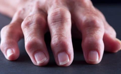 
Crece enfermedad artritis reumatoide

