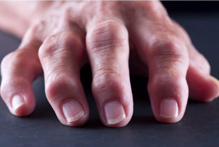 Crece enfermedad artritis reumatoide