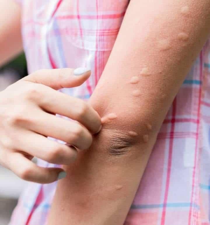 El frío da urticaria