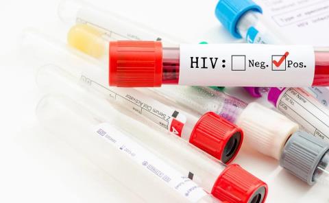 Logran eliminar el VIH
