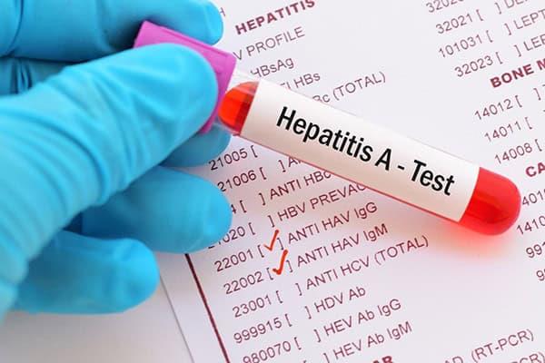 Confirman 50 casos de hepatitis este año