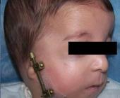 Malformación de cráneo en bebés