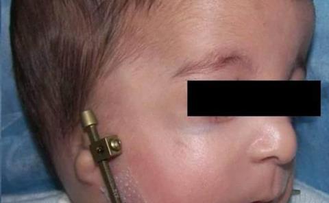 Malformación de cráneo en bebés
